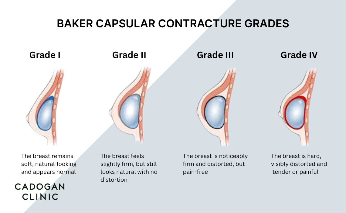 An infographic showing the stages of capsular contracture